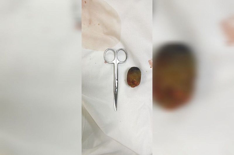 Краснодарские хирурги удалили огромный камень пожилой пациентке с ожирением