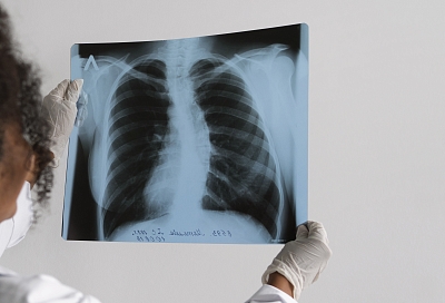 Бегом на рентген: только с его помощью эти люди смогут избежать рака легких