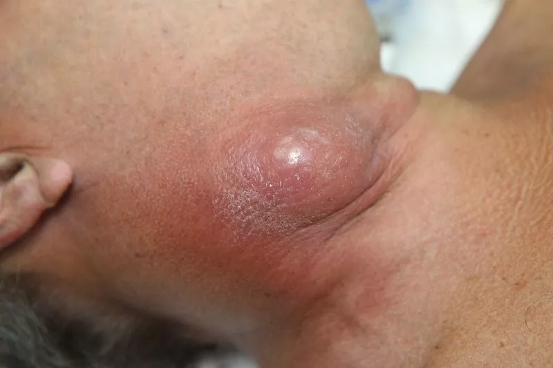 Образование оказалось злокачественной опухолью. 