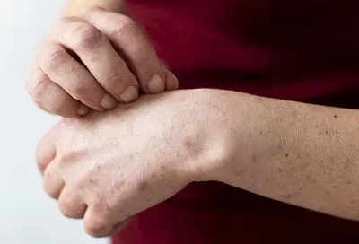 Стригущий лишай: как распознать, лечить и защититься