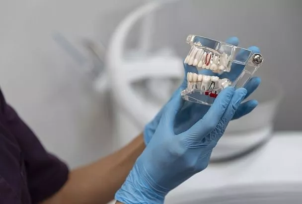 Российские ученые нашли способ снизить риск отторжения зубных имплантов