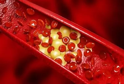 Ржавчина жизни: как себе помочь при атеросклерозе