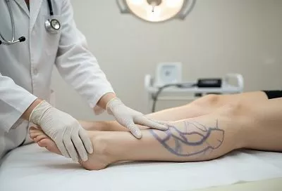 Главные признаки опасного варикоза: важные "звоночки" 