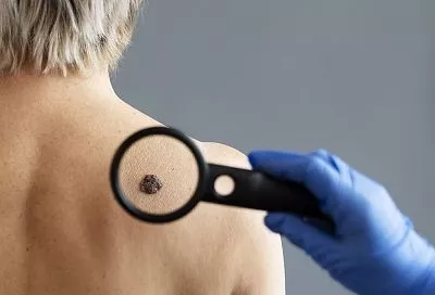 Надо ли удалять родинки: правда от онколога, которая вас сильно удивит