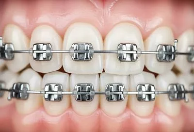 Брекеты не вредят зубной эмали: стоматологи развеяли опасения