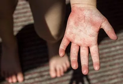 В Адыгее зафиксирован первый за 15 лет случай заражения краснухой