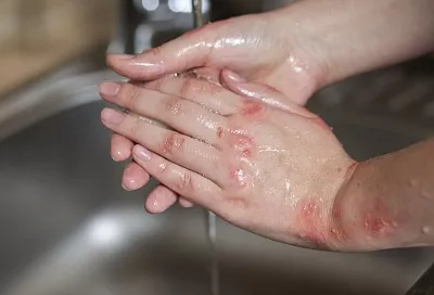 В Кубанском медицинском университете разработают покрытия и импланты для ускоренного заживления ожогов