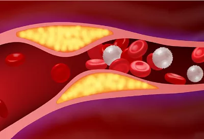 Сосуды и сердце в опасности: как избыток жирной пищи вредит здоровью