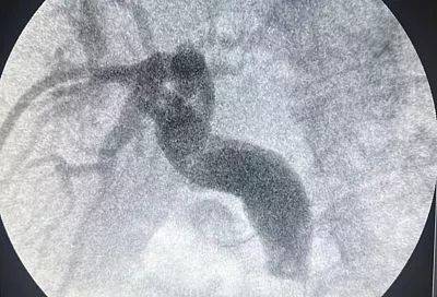 Врачи в Краснодаре избавили пациента от крупного камня в желчном протоке через прокол со стороны печени