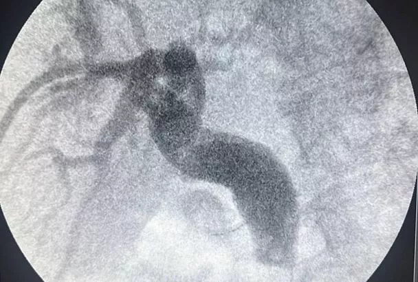 Врачи в Краснодаре избавили пациента от крупного камня в желчном протоке через прокол со стороны печени