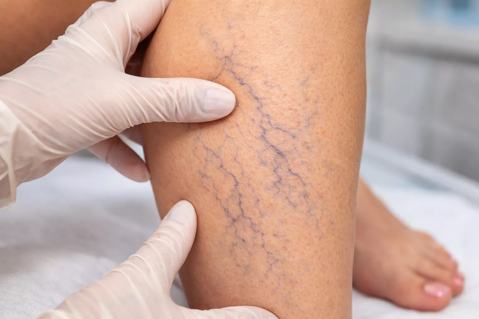 Синяя сеточка из вен на ногах: флебологи дали ответ всем женщинам после 40 – теперь не так страшно