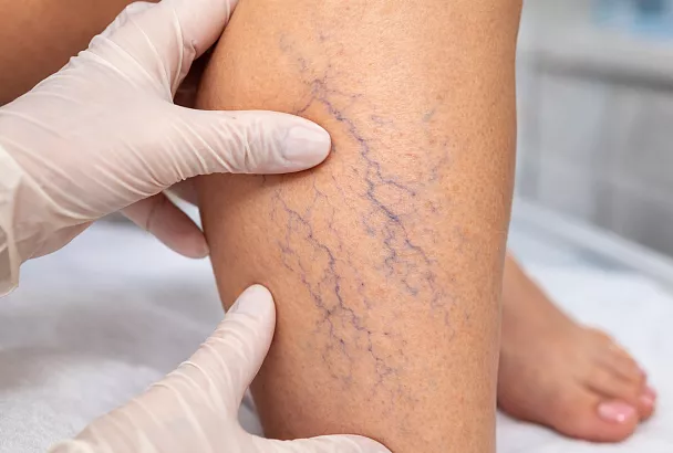 Синяя сеточка из вен на ногах: флебологи дали ответ всем женщинам после 40 – теперь не так страшно