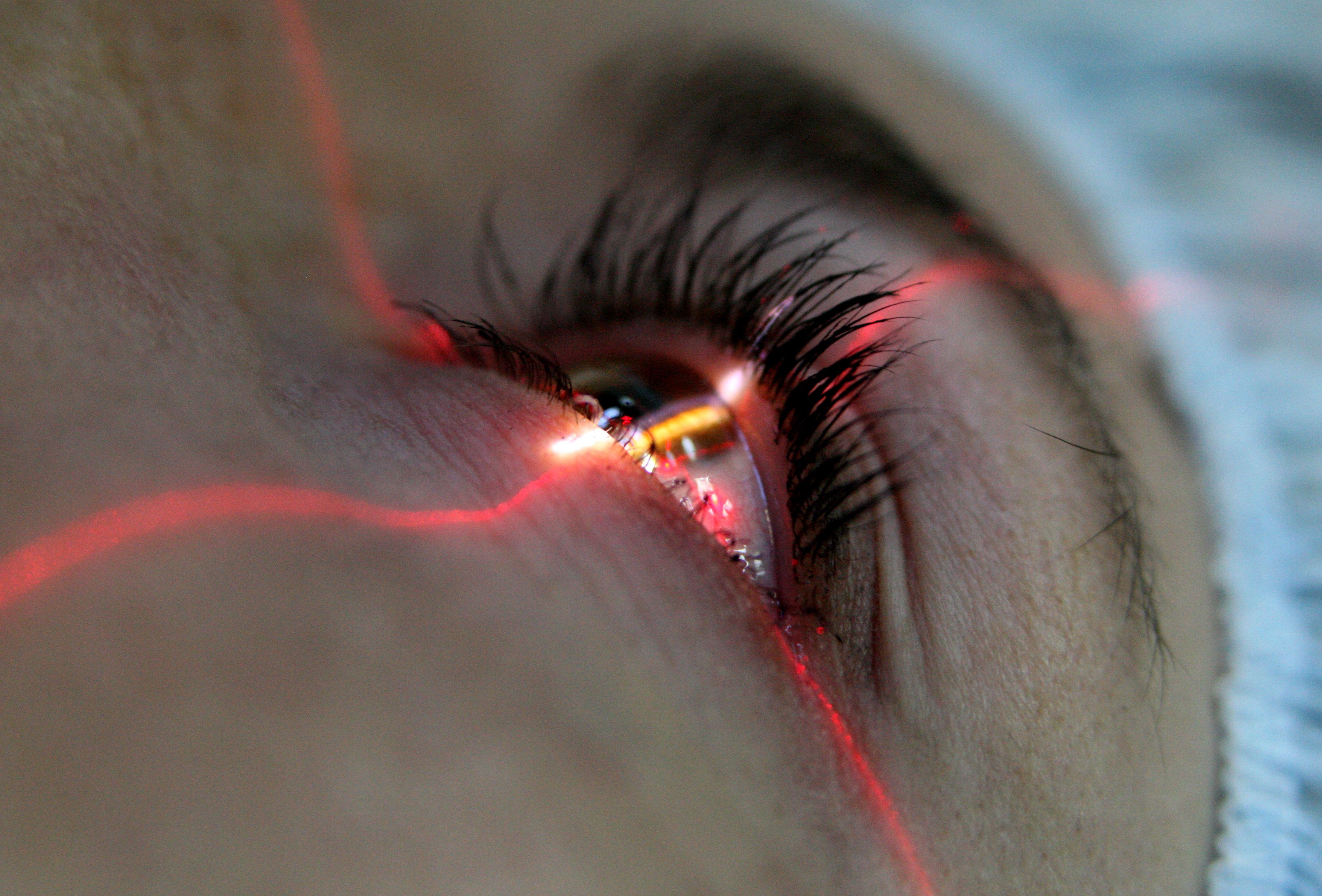 Вызвать глаз. Лазерная коррекция зрения. Лазерная операция на глаза. Лазерная коррекция зрени.