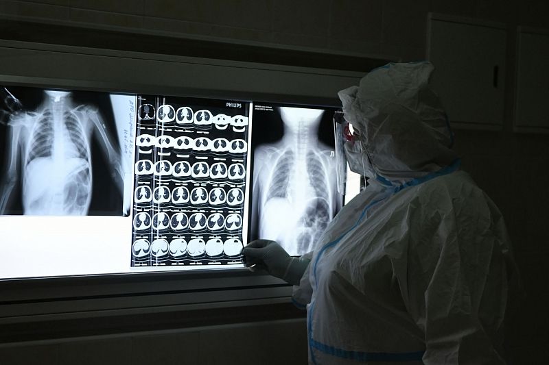 В Минздраве предупредили о способности коронавируса пробуждать туберкулез 