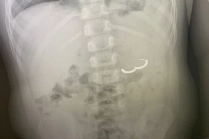 В Туапсе врачи достали золотую серьгу из желудка 4-летнего мальчика