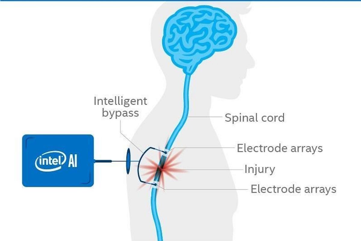 Intel начал работу над чипом, который позволит ходить парализованным