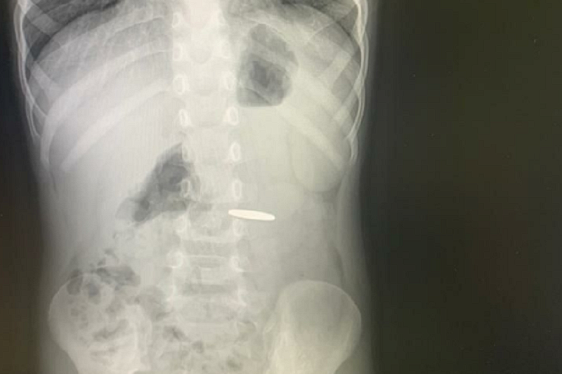 В Туапсе врачи достали монету из желудка 3-летнего ребенка