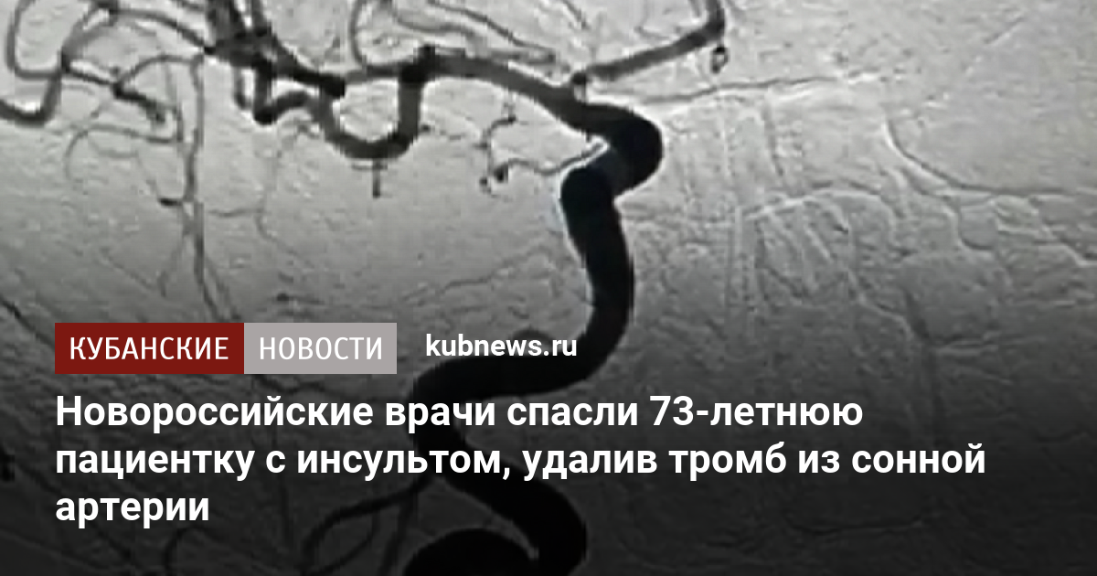 Новороссийские врачи спасли 73-летнюю пациентку с инсультом, удалив ...