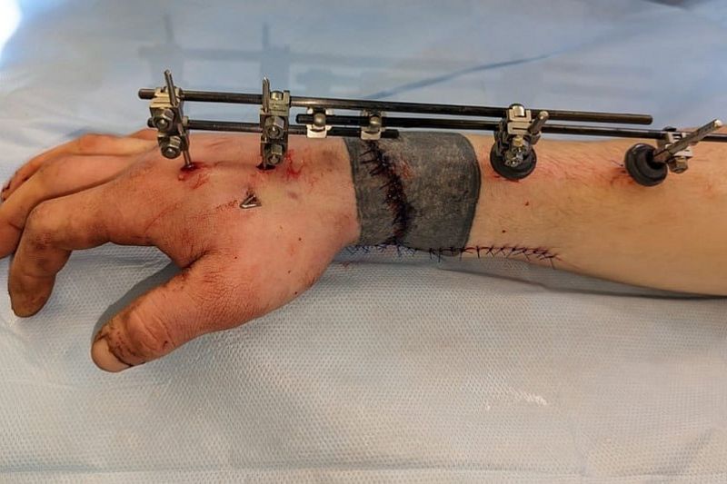 Краснодарские врачи пришили 22-летнему пациенту отрубленную топором кисть  