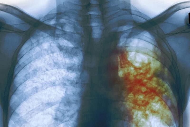 В Краснодарском крае больного туберкулезом в судебном порядке отправили на принудительное лечение