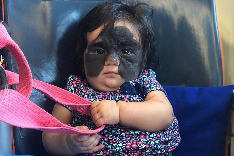 Девочка с «маской Бэтмена» прилетела из США в Краснодар на лечение