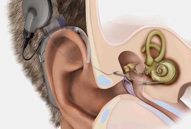 В Пермском университете разработали бионическое ухо