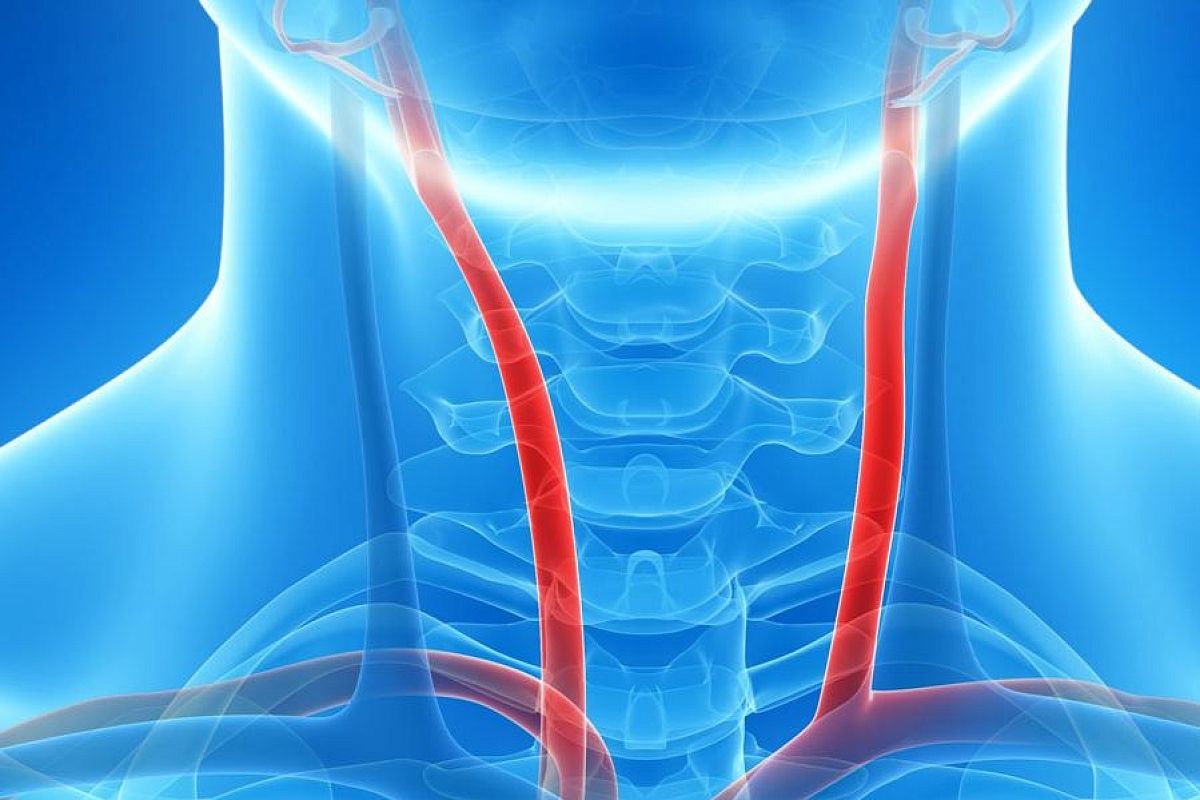 Бомба замедленного действия: почему так опасна аневризма сонных артерий