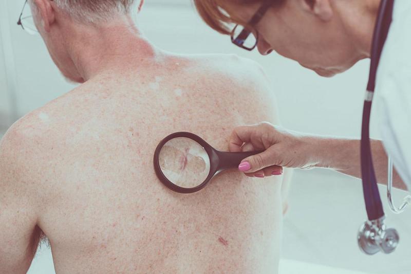 Прибор, моментально определяющий рак кожи, готов к серийному производству