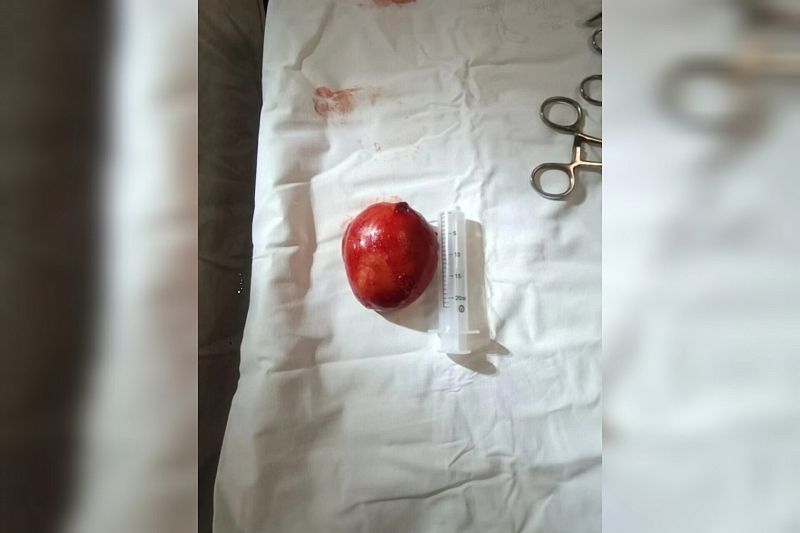 Новороссийские врачи спасли пациента, удалив 10-сантиметровую кисту на шее