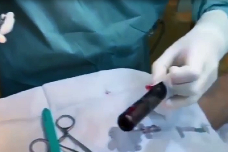 Операцию на открытом сердце провели военные врачи медбатальона ЮВО в зоне СВО