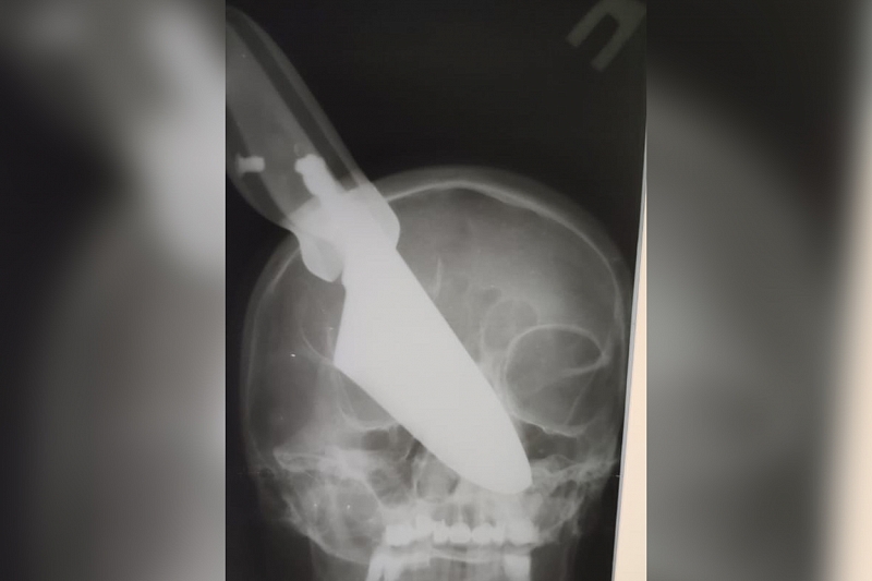 В Апшеронске врачи достали 25-сантиметровый нож из головы женщины