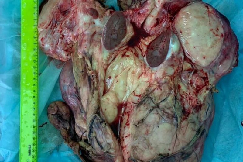 10-килограммовую опухоль удалили пациенту краснодарские хирурги  