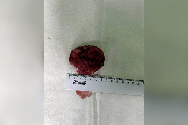 Краснодарские онкоурологи удалили пациентке сложную 6-сантиметровую опухоль