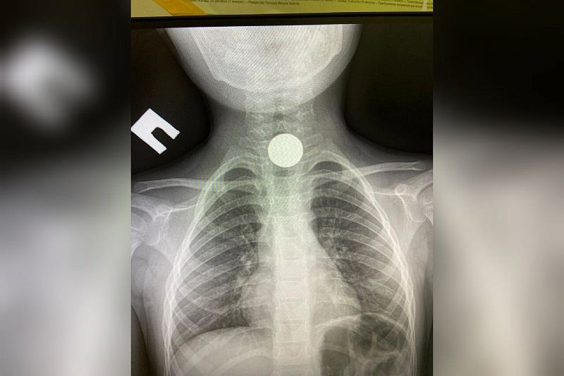 На Кубани врачи достали монету из пищевода 4-летнего мальчика