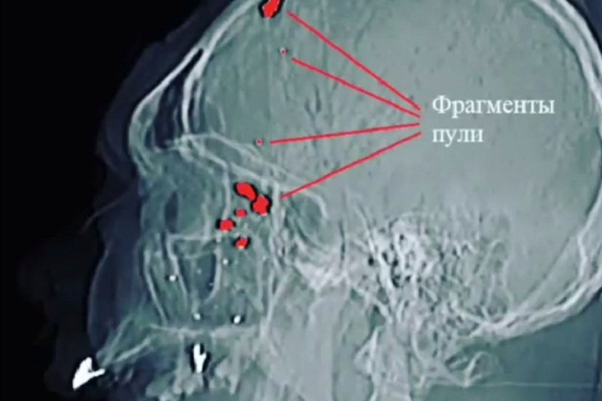 Врачи спасли мужчину с огнестрельным ранением головы