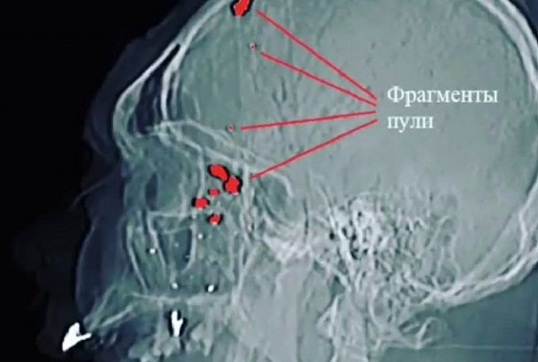 Врачи спасли мужчину с огнестрельным ранением головы