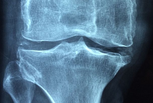  Как распознать остеопороз на ранней стадии: советы эндокринолога