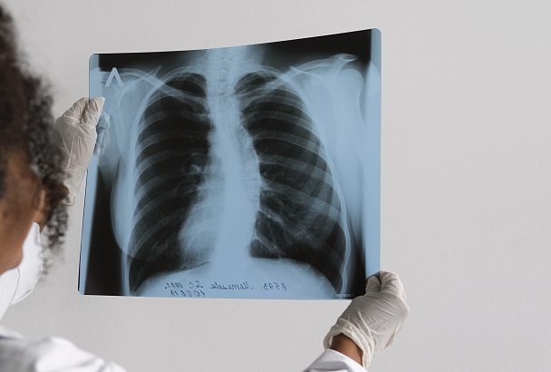 Бегом на рентген: только с его помощью эти люди смогут избежать рака легких