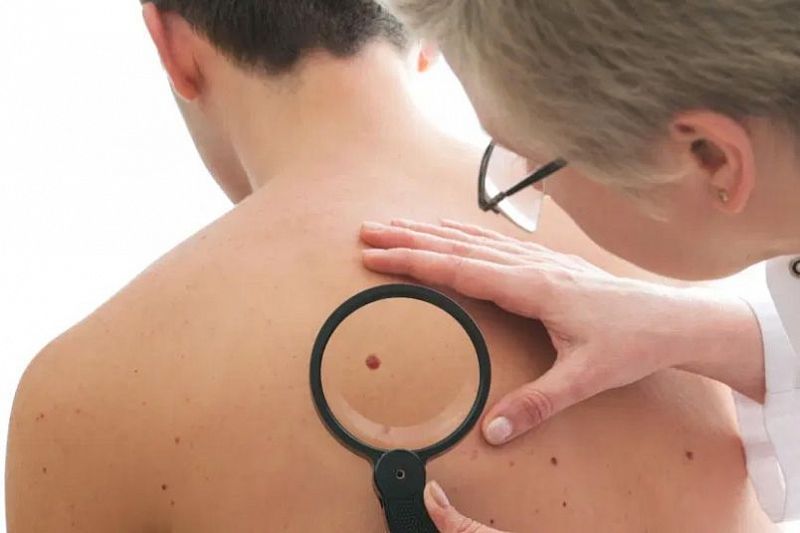 Пять знаков на вашем теле, которые помогут вычислить рак кожи
