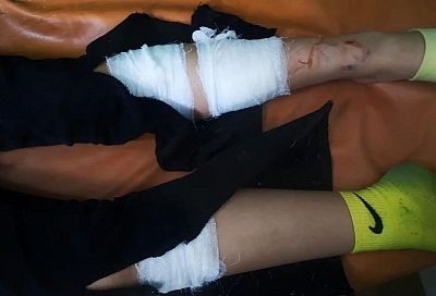 Раны на ногах и руках: в районе парка «Краснодар» свора собак напала на 11-летнюю девочку