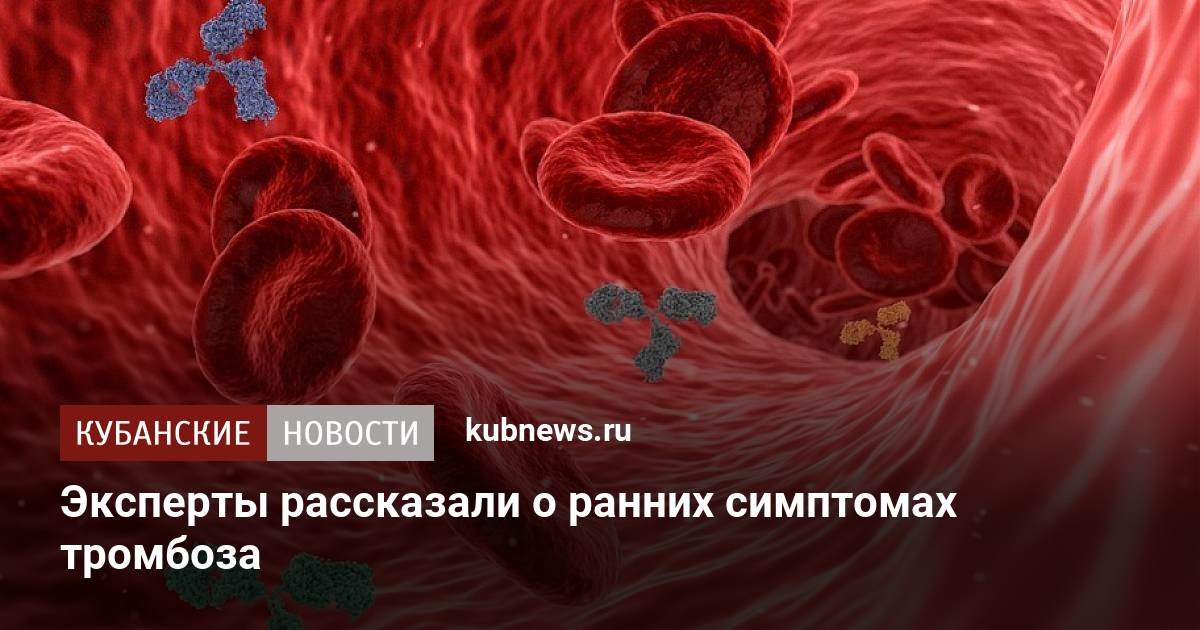 Код мкб тромбоз нижних. Тромбоз почек Патан. Илеофеморальный тромбоз.