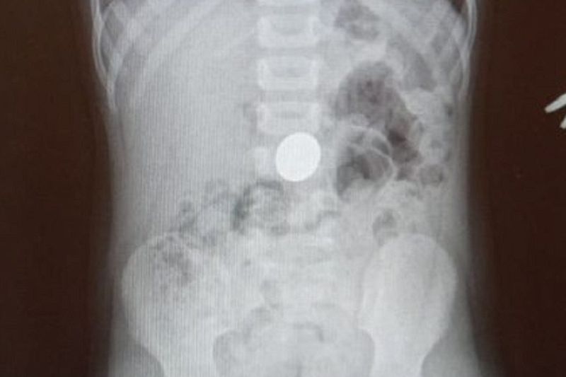 В Туапсе врачи достали пятирублевую монету из желудка 4-летнего мальчика