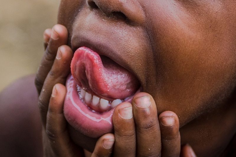Новый симптом коронавируса - сыпь во рту и на языке