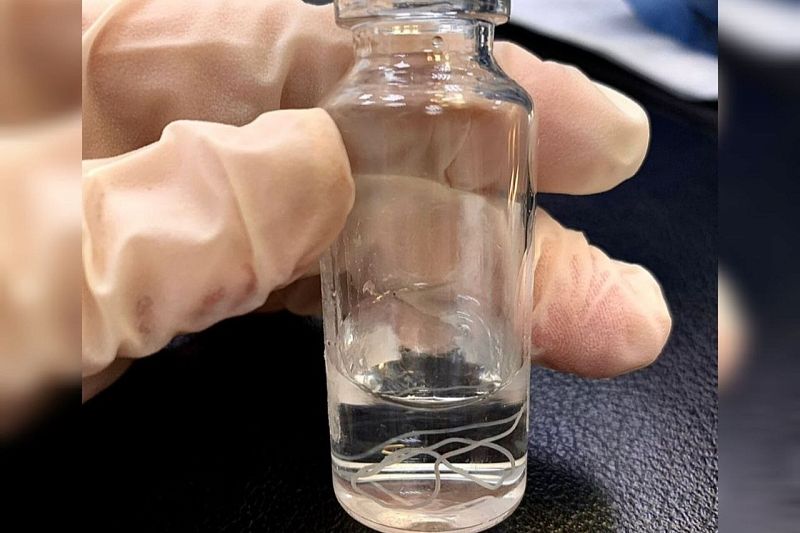 Опасный укус комара: в Краснодаре из тела женщины достали червя-паразита
