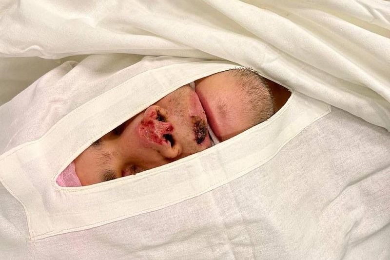 Краснодарские врачи восстановили мужчине откушенный в драке нос 