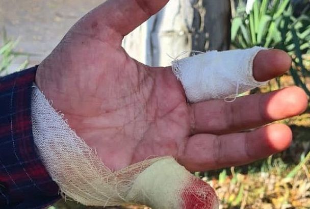 Помешал искать закладку: в Анапе двое мужчин отрезали охраннику палец