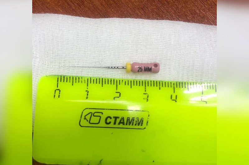 В Новороссийске из желудка пациентки достали стоматологический инструмент