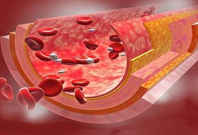 Как почистить сосуды в домашних условиях: вот для чего вашему организму нужен эндотелий, и как его восстановить