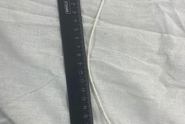 Новороссийские хирурги извлекли из сердца пациентки 20-сантиметровый катетер