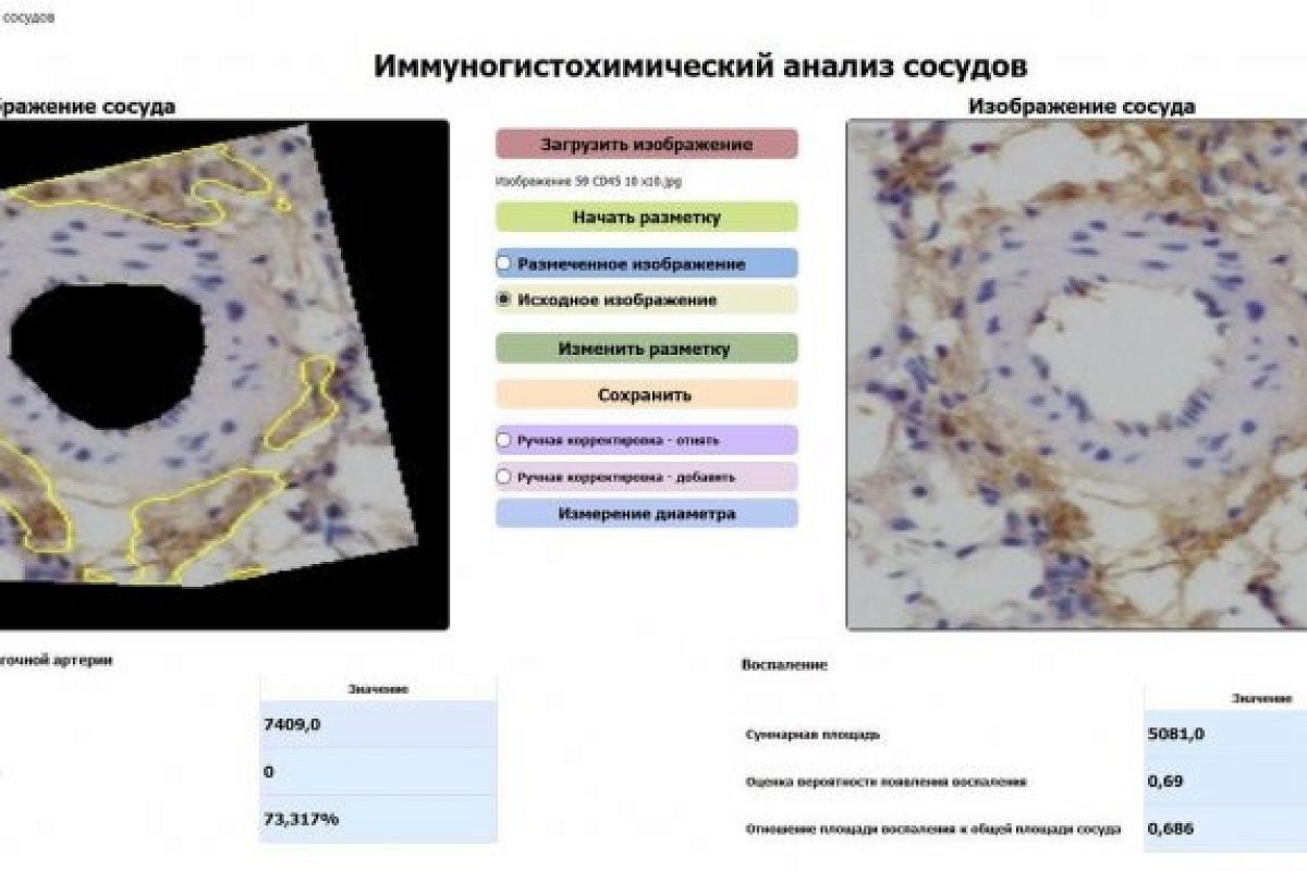 Ученые из Санкт-Петербурга создали новый препарат для лечения рака легких